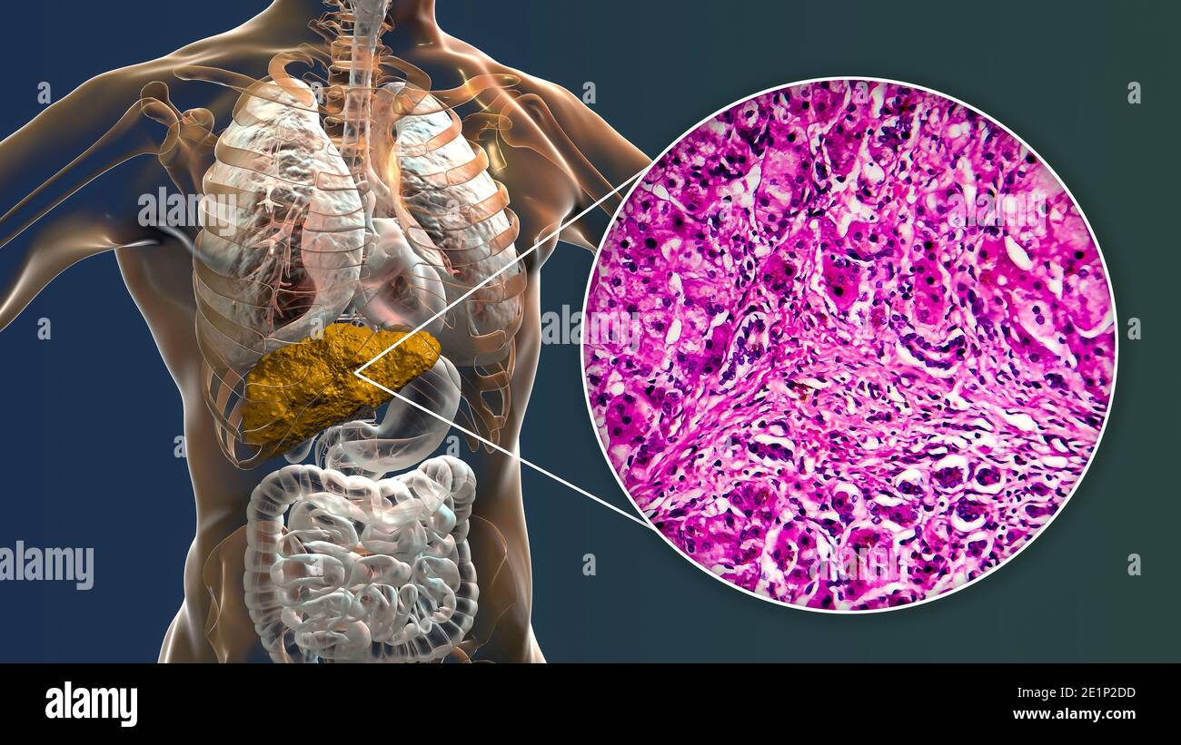 Cirrhose du foie, illustration et micrographe léger Banque D'Images