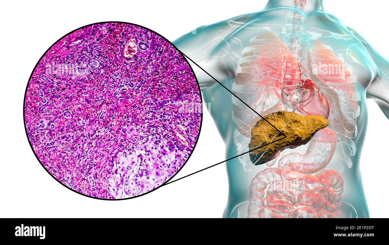 Cirrhose du foie, illustration et micrographe léger Banque D'Images