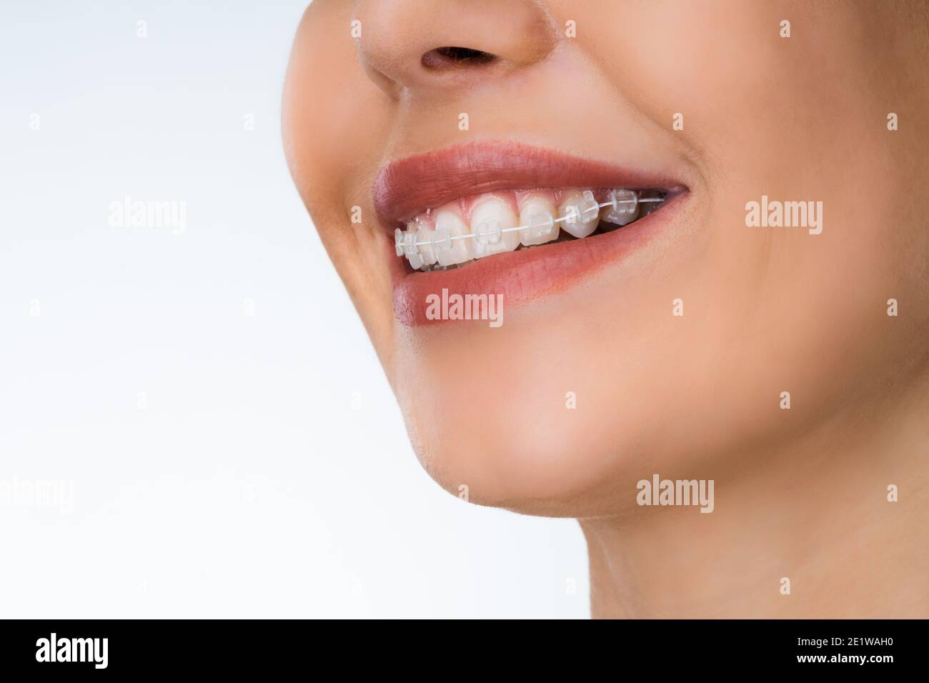 Supports Dentaires En Céramique Orthodontique Roth/MBT - Lot De 10, Fente 0.022, Crochet Rouge, Certifié CE