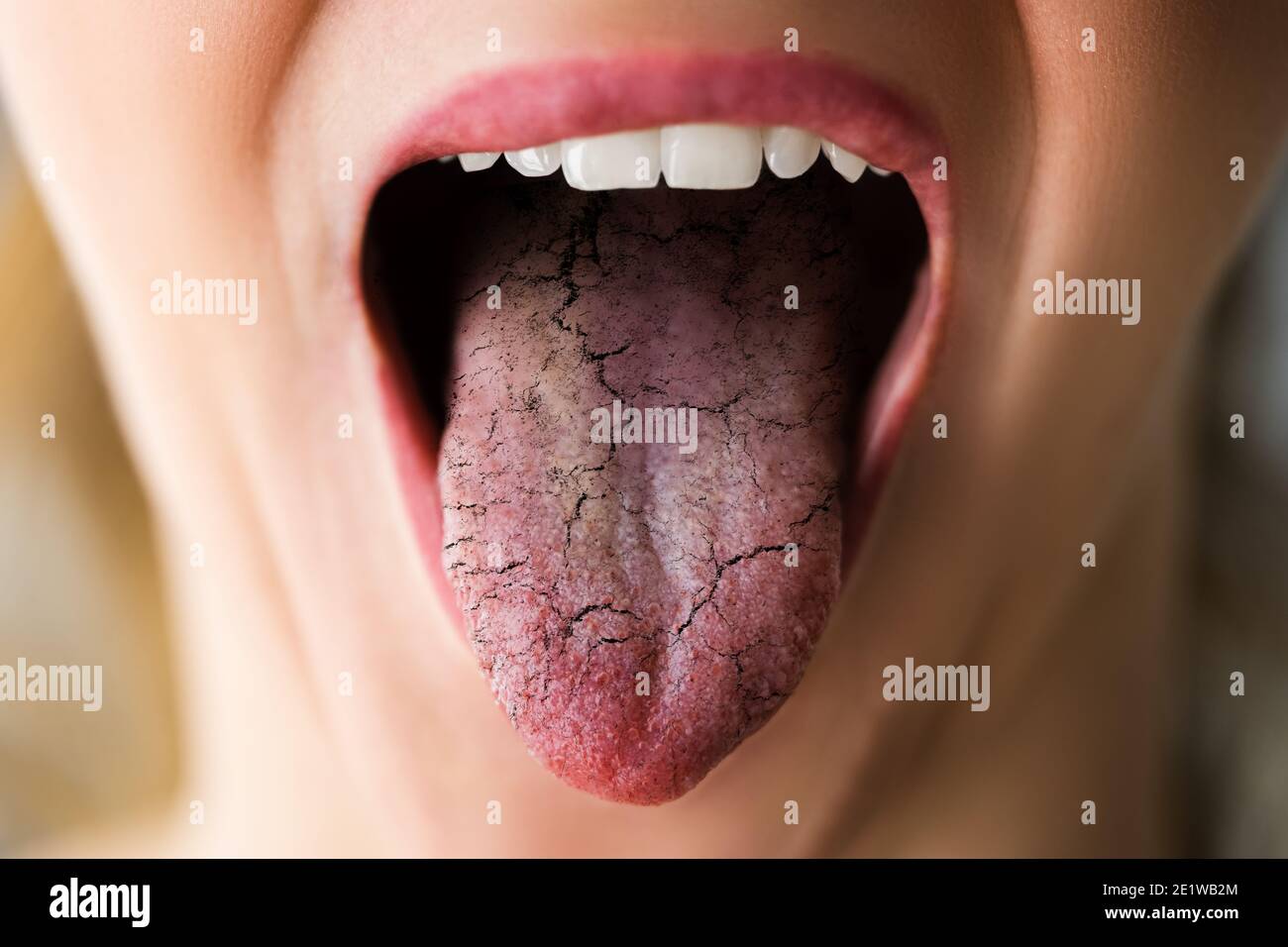 La langue de la femme avec la candidose et la douleur de mauvaises bactéries Banque D'Images