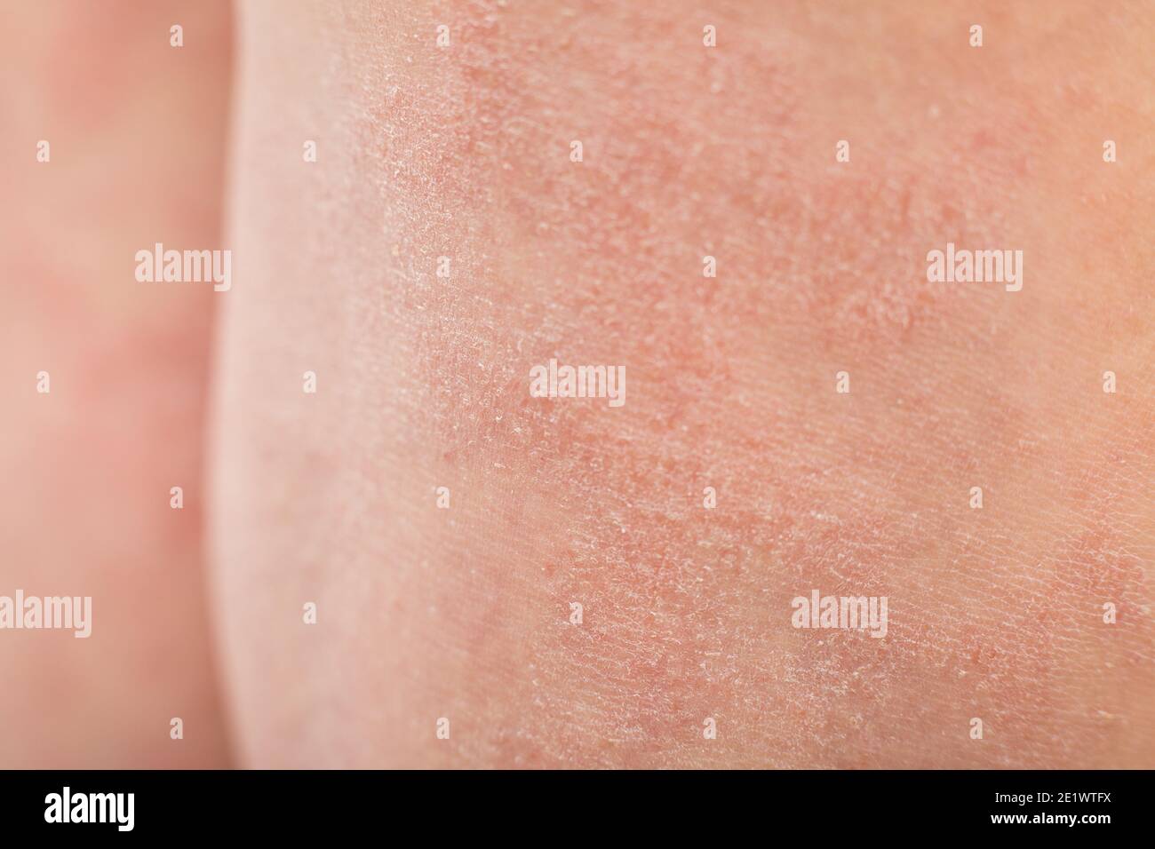 Gros plan l'eczéma atopique sévère sur les jambes derrière les genoux d'un enfant est une maladie dermatologique de la peau. Grande éruption cutanée rouge, enflammée, squameuse sur le Banque D'Images