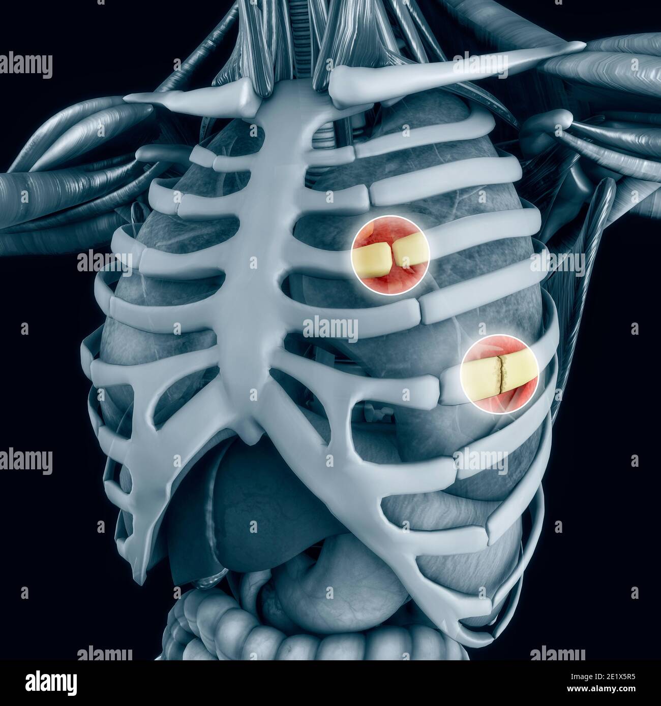 L'anatomie et le corps humain. Séparation Costochondrale, nervure séparée. Nervures cassées et fracturées. Les os de la cage thoracique se rompt ou se fendillent. Poumons de poitrine Banque D'Images