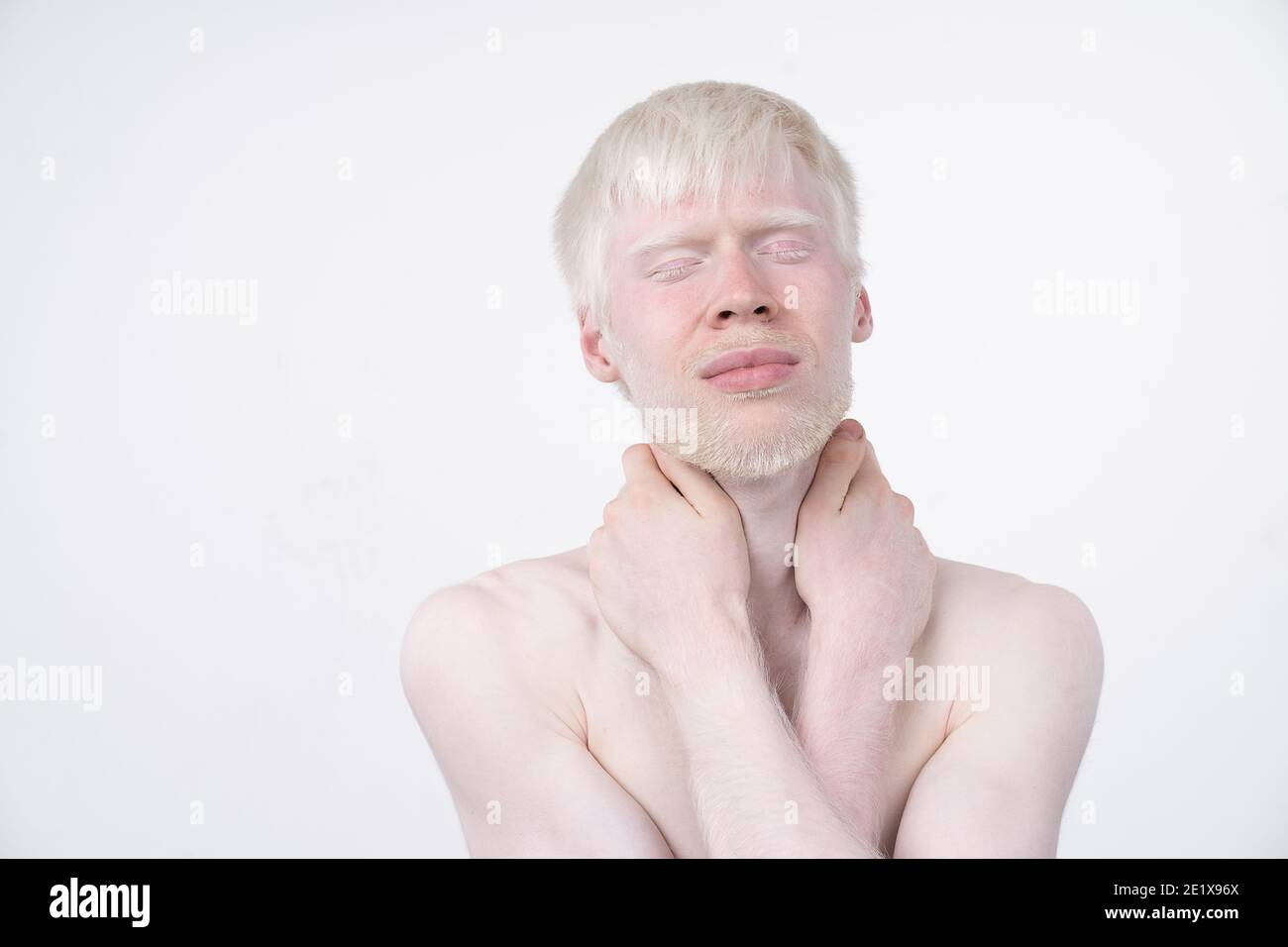 albinisme albinos homme en studio vêtu t-shirt isolé sur fond blanc. déviations anormales. aspect inhabituel. anomalie de la peau Banque D'Images