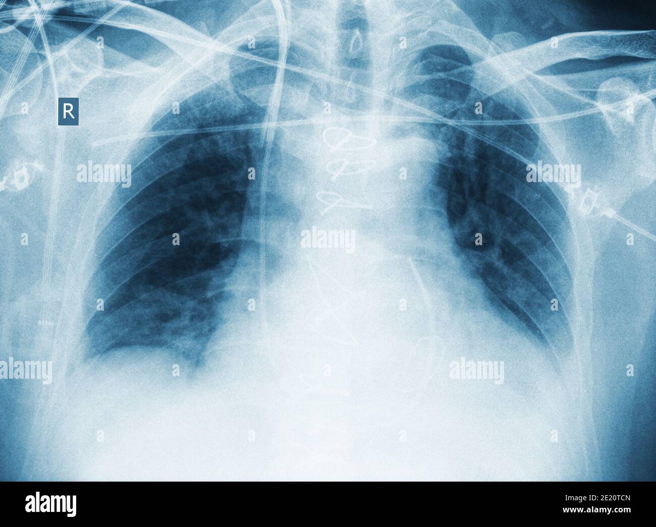 Image radiographique d'un patient gravement malade. Banque D'Images
