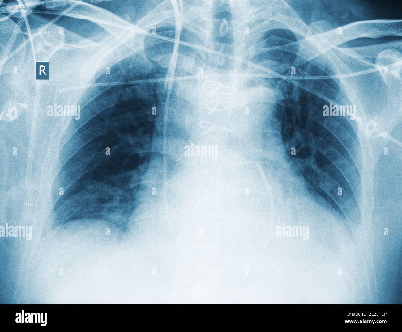 Contrôle des rayons X après une chirurgie cardiaque du patient. Banque D'Images