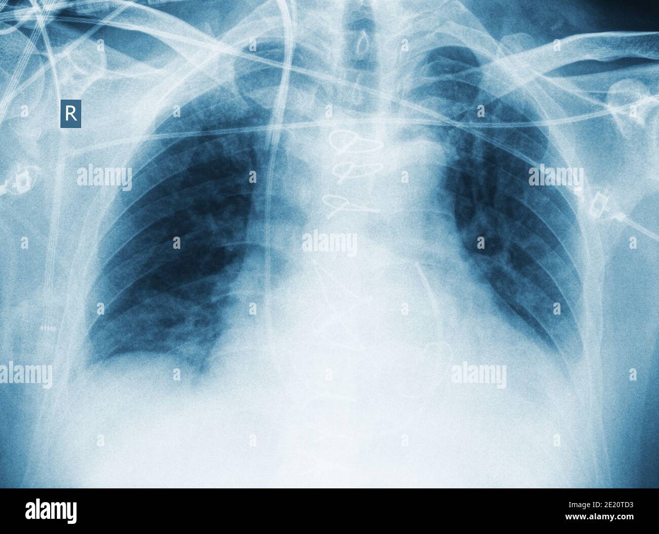 Radiographie du patient après une intervention chirurgicale avec pneumonie. Banque D'Images