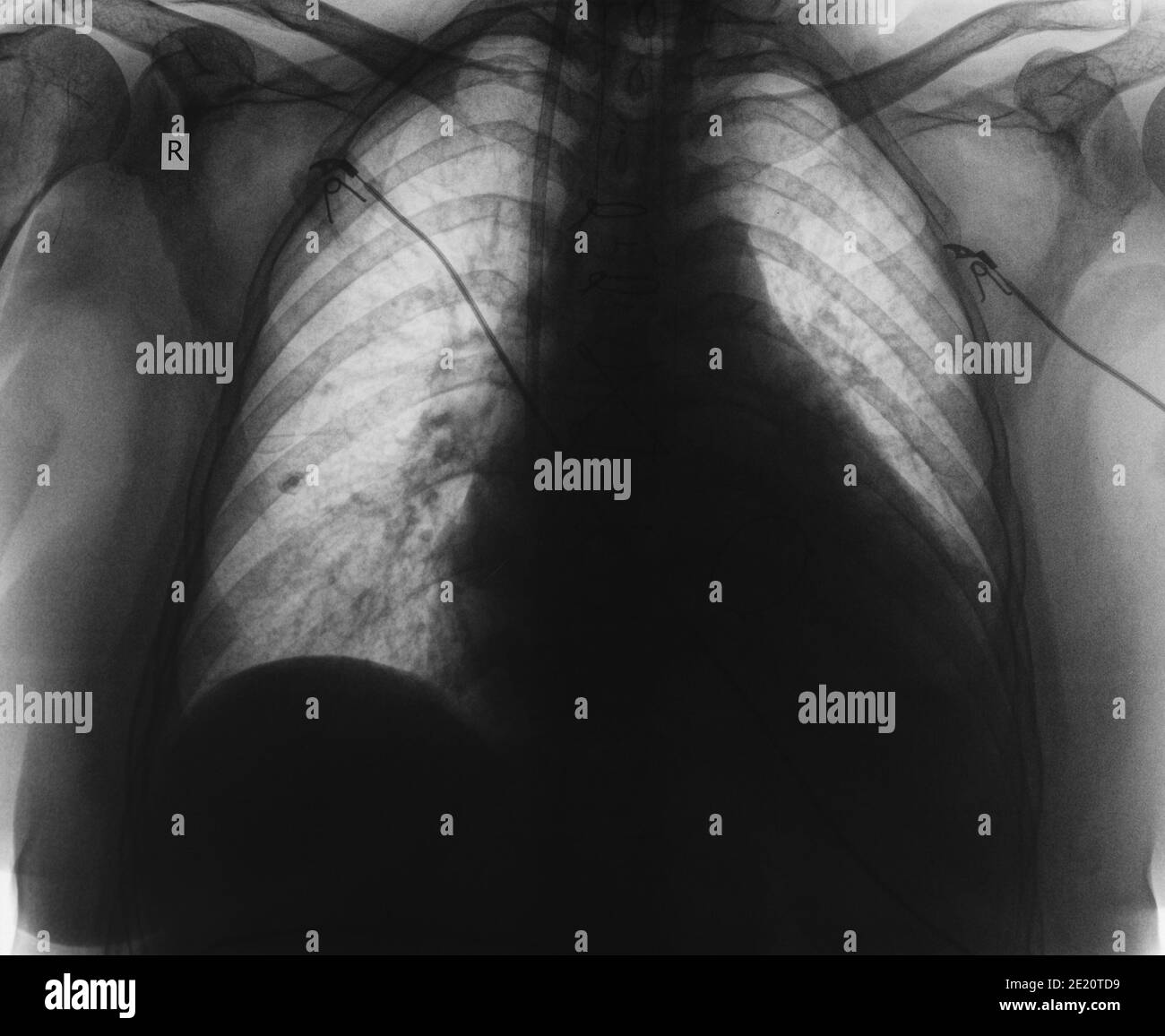 Image de Roentgen du patient en USI. Banque D'Images