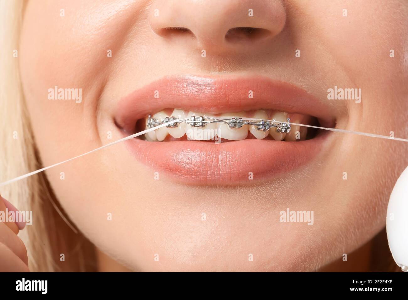 Jeune femme avec bretelles dentaires et soie dentaire, gros plan Photo  Stock - Alamy