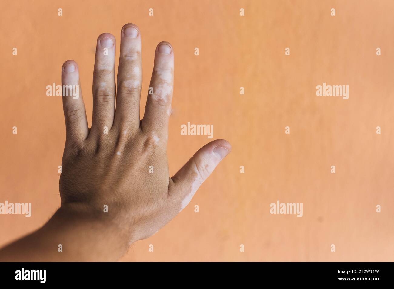 Vitiligo sur la main sur un fond Banque D'Images