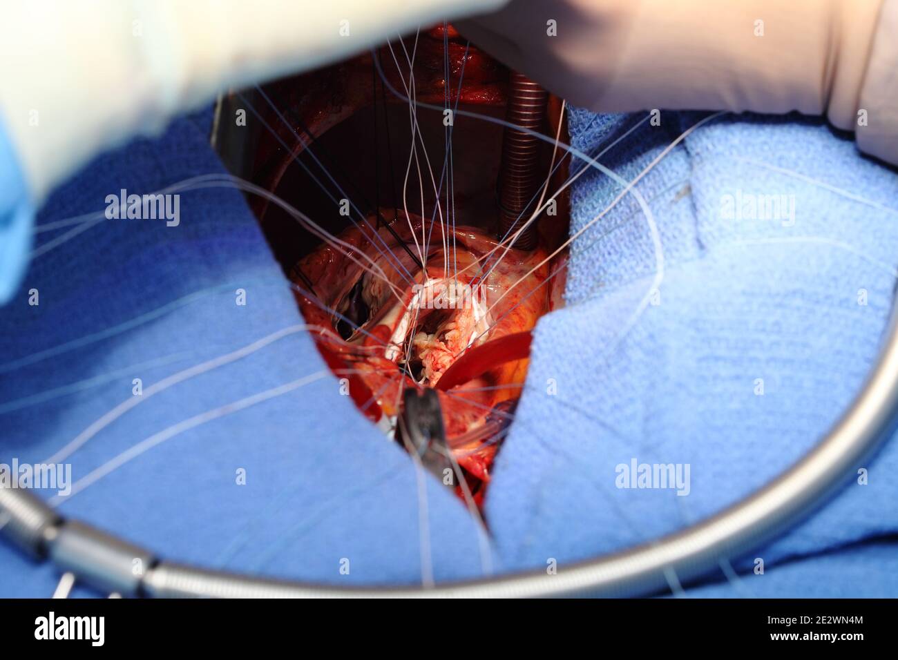 Traitement chirurgical de la maladie valvulaire. Banque D'Images