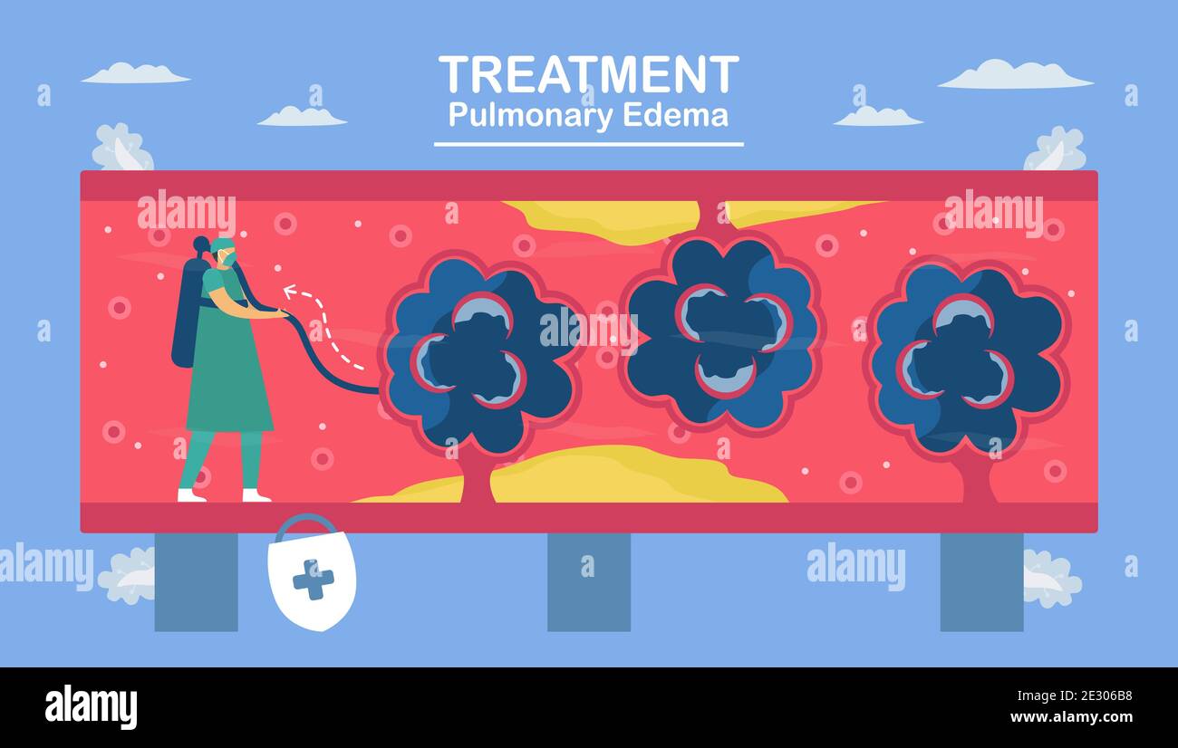 L'oedème pulmonaire est le symptôme que les poumons se remplissent de liquide. Traitement et diagnostic. Le corps peine à obtenir assez d'oxygène jusqu'à l'essoufflement. Illustration de Vecteur