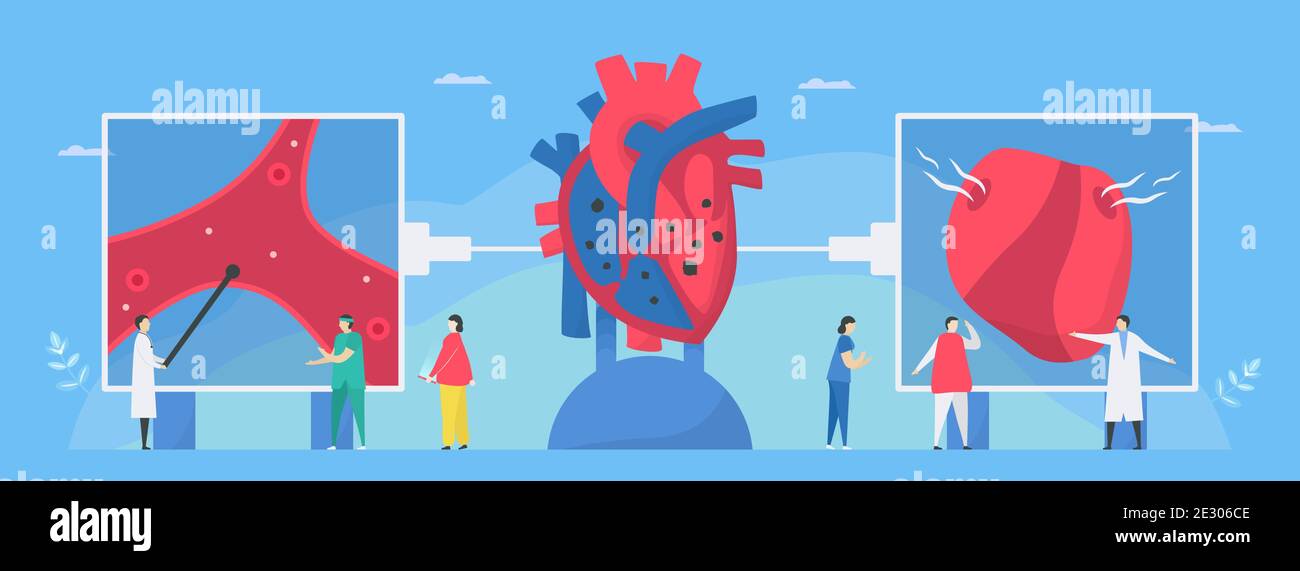 Illustration du vecteur cardiologique. Cette maladie appelle endocardite. C'est une infection de l'endocarde qui est des chambres et des valves cardiaques internes. Facteur de risque i Illustration de Vecteur