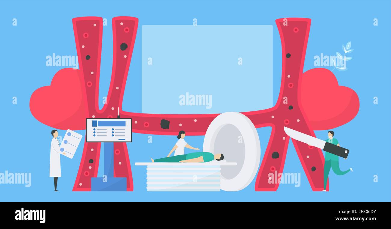 Illustration du vecteur cardiologique. Cette maladie appelle endocardite. C'est une infection de l'endocarde qui est des chambres et des valves cardiaques internes. Diagnostic an Illustration de Vecteur