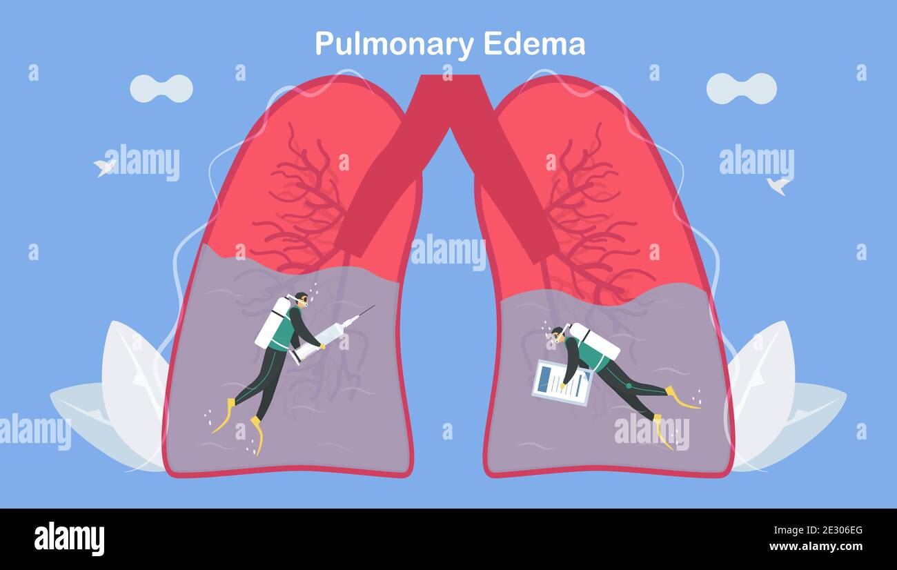 L'oedème pulmonaire est le symptôme que les poumons se remplissent ...