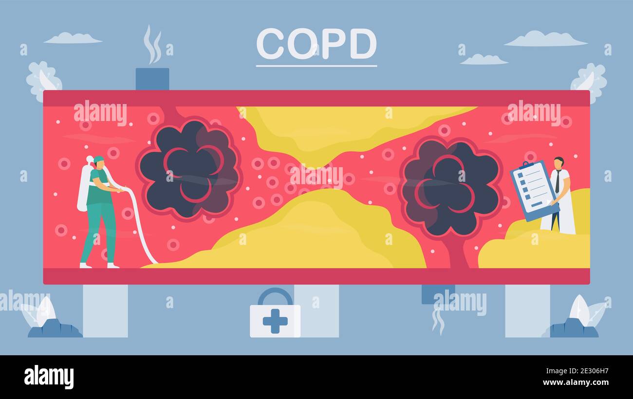 Maladie pulmonaire obstructive chronique ou MPOC. Les poumons ont des
