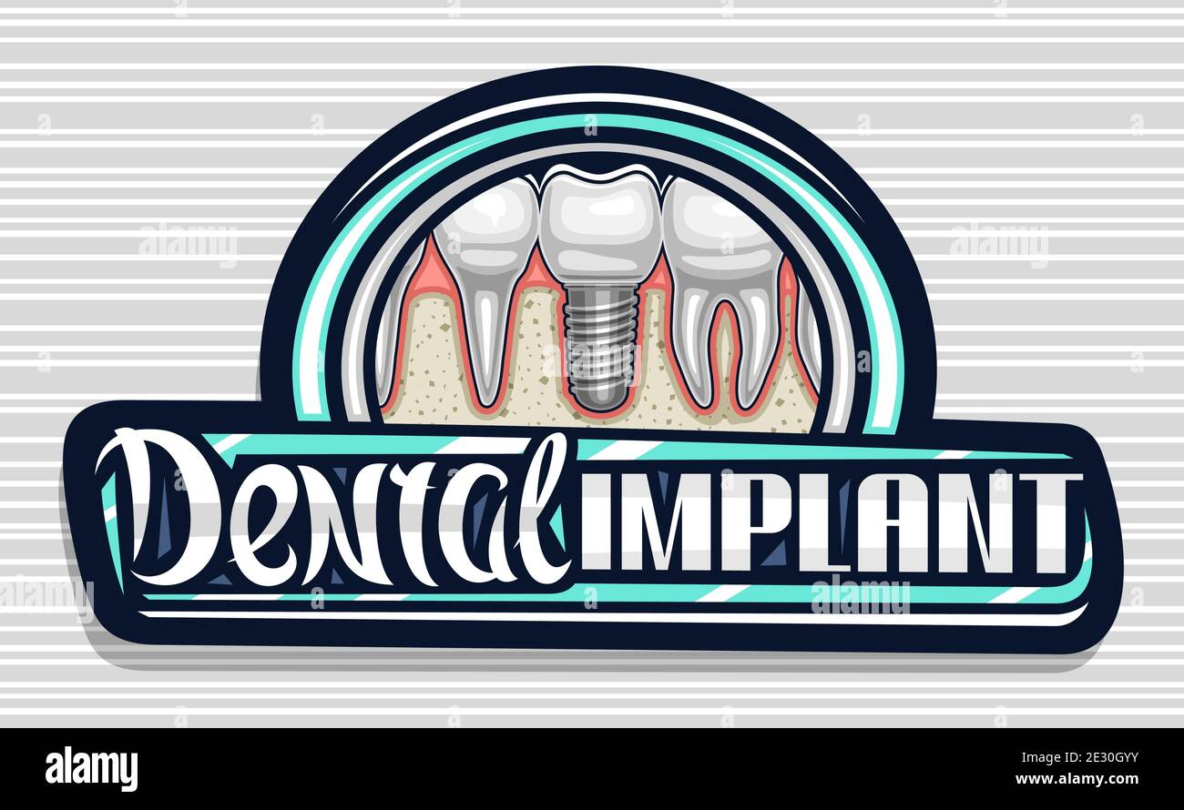 Logo vectoriel pour la clinique d'implant dentaire, panneau d'affichage décoratif foncé avec illustration de molaire en porcelaine avec vis, lettrage calligraphie unique pour le WO Illustration de Vecteur