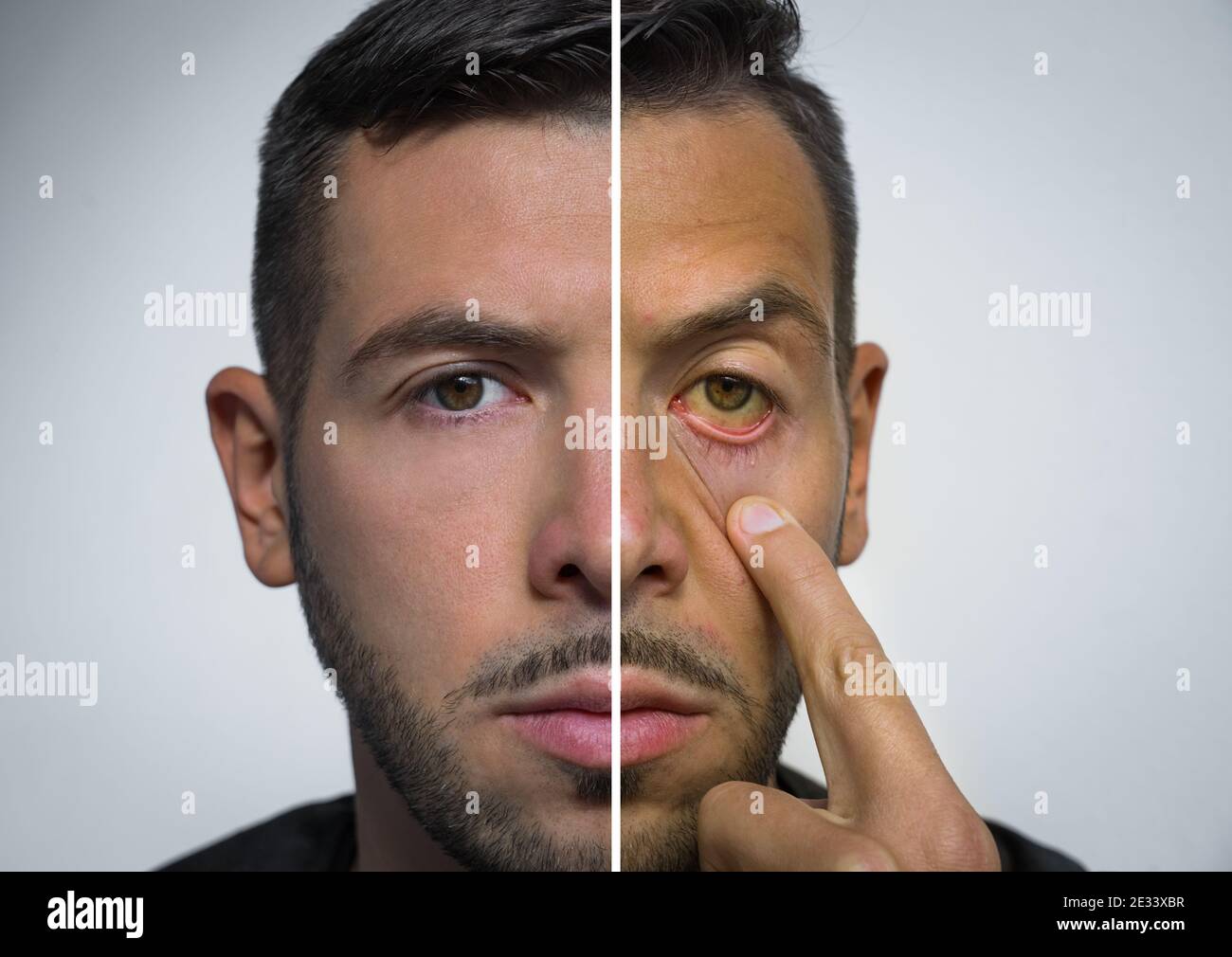 Le visage de l'homme divisé en deux parties, l'une saine et l'autre  malsaine. Alcool Photo Stock - Alamy