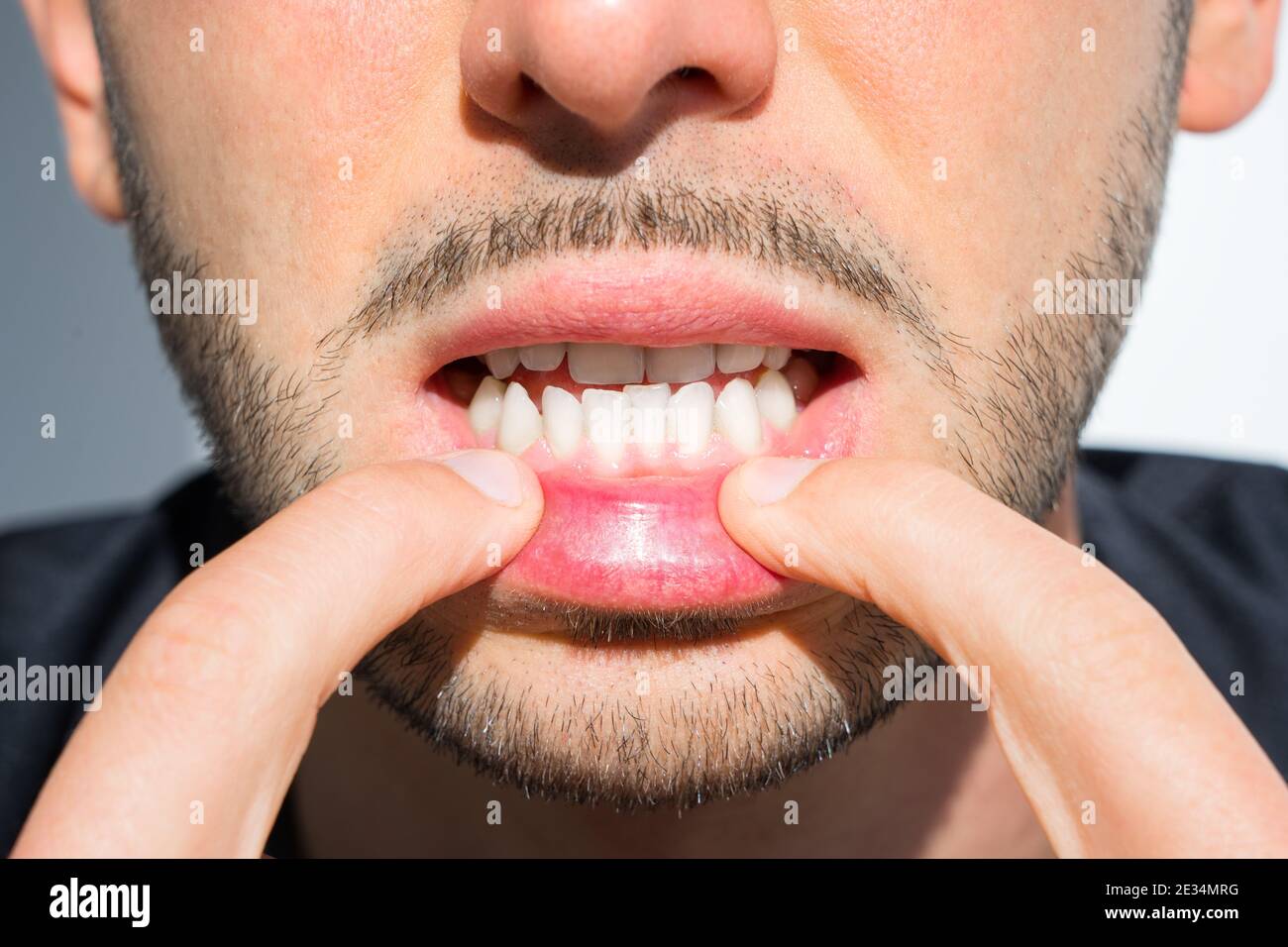 Dents tortravers de jeune homme. Raison d'installer des entretoises. Mauvaises dents Banque D'Images