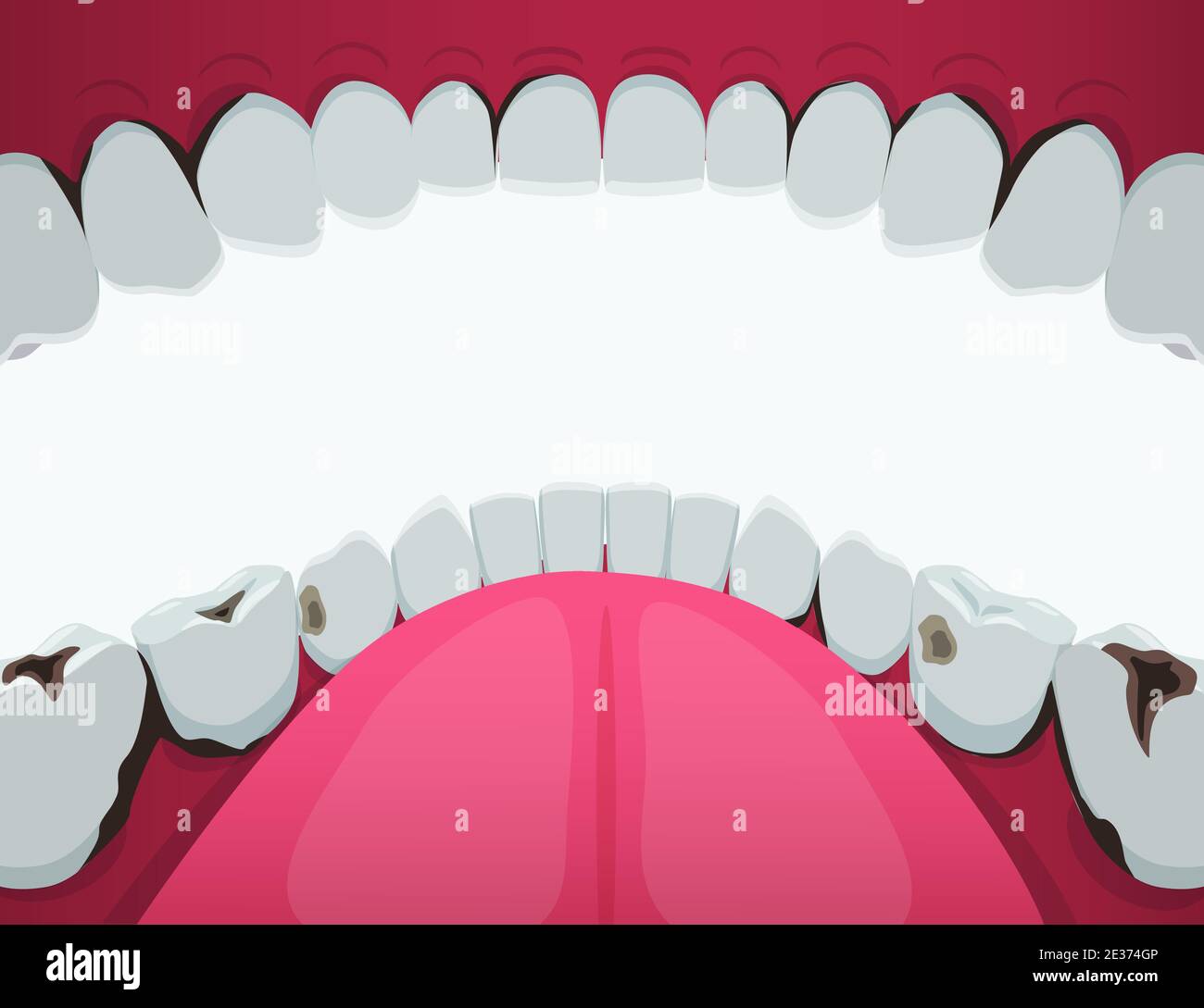 Dents endommagées par une clipart de cavité buccale de carie. Trous noirs et dents fissurées et développement de fracture dentaire. Illustration de Vecteur