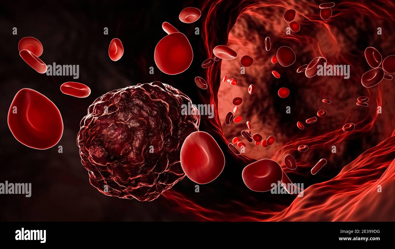 Cellule cancéreuse ou tumeur cancéreuse au milieu des globules rouges circulant dans un vaisseau sanguin, une artère ou une veine. Illustration du rendu 3D. Médecine, pathologie, oncolo Banque D'Images