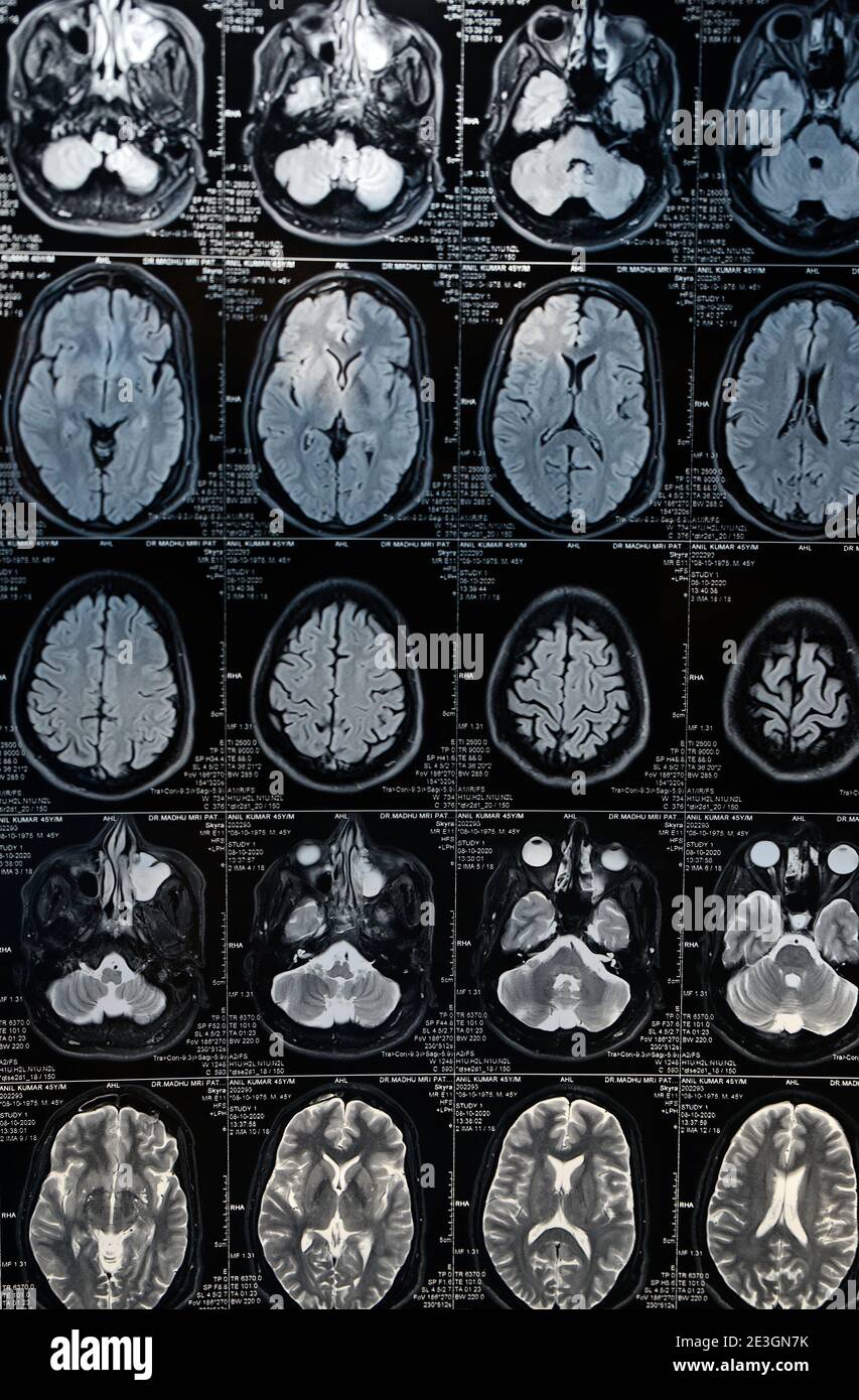 IRM cerveau de la tête et du crâne Banque D'Images
