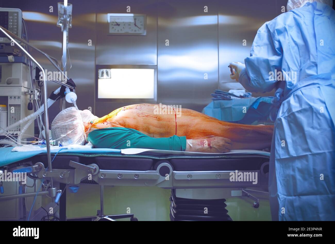 Le patient est anesthésié. Traitement du corps et préparation pour la chirurgie. Banque D'Images