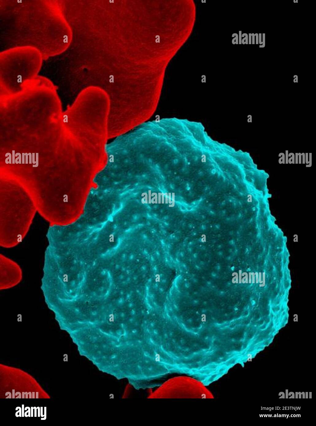 Globules rouges infectés par le paludisme. Banque D'Images