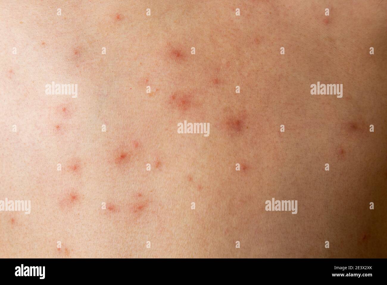 Eczéma gros plan sur un corps humain Photo Stock Alamy