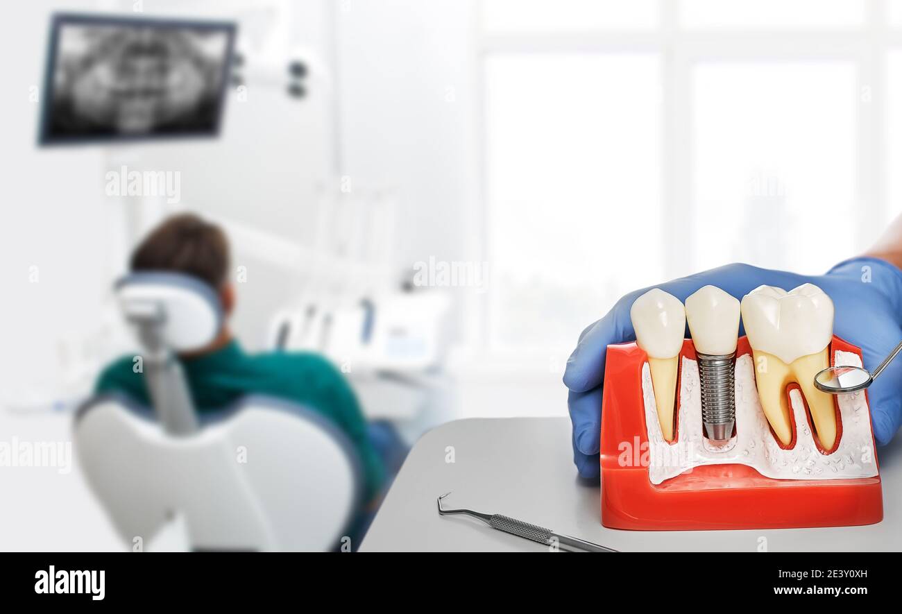 Médecin montrant l'installation d'un implant dentaire sur le modèle anatomique des dents, au-dessus de la séance dentaire de fond pour le patient à la clinique Banque D'Images