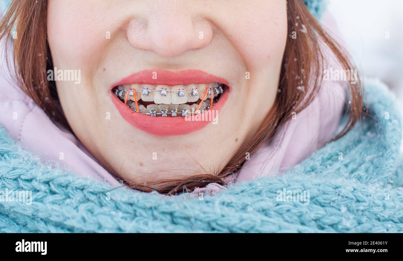 La fille a des bretelles sur ses dents. Une fille en hiver sur la rue  sourires et bretelles sont visibles sur ses dents. Sur les zooms sont de  couleur élastique bande Photo