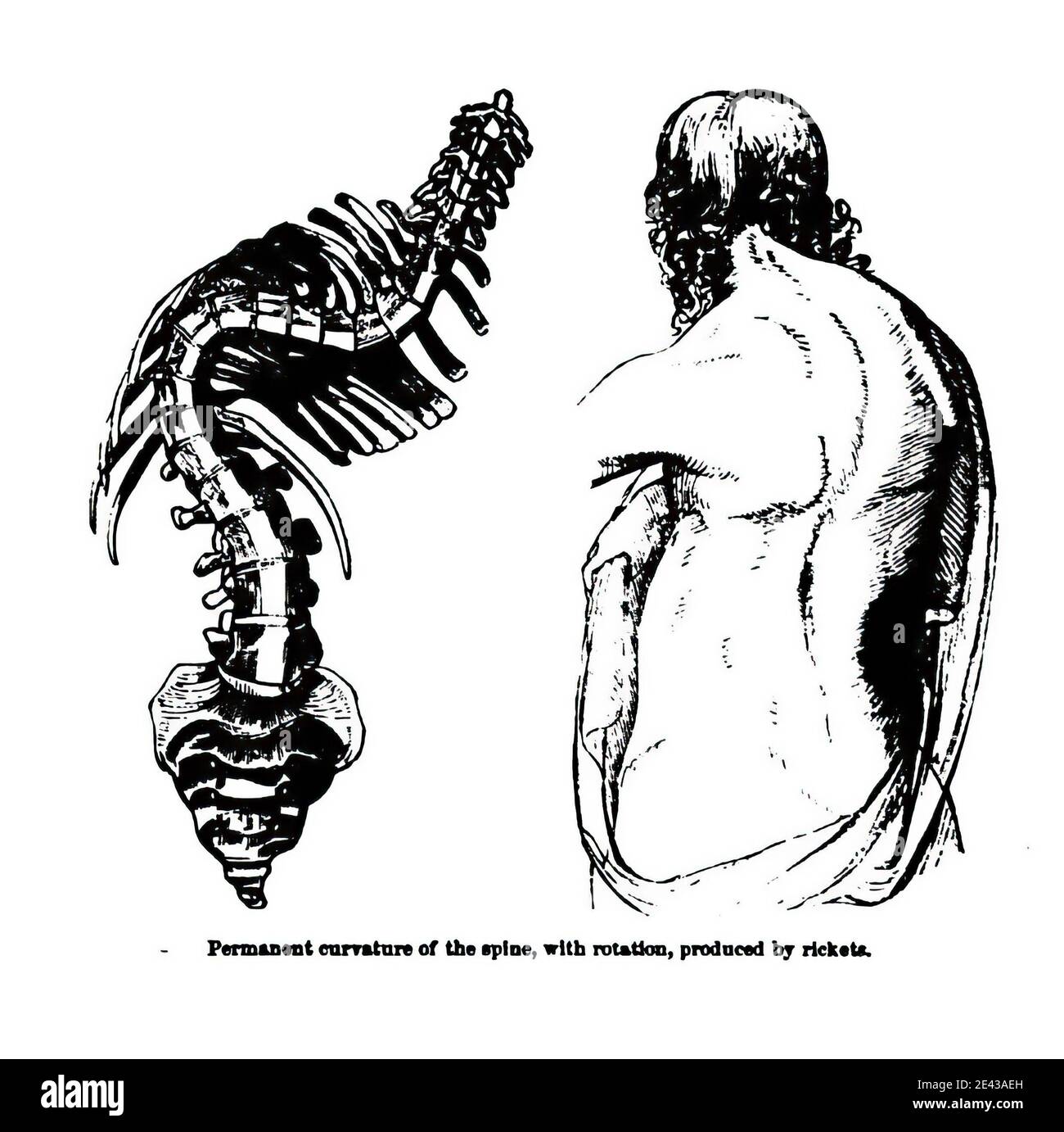 Illustration verticale de la colonne vertébrale incurvée d'une personne - maladie de scoliose Banque D'Images