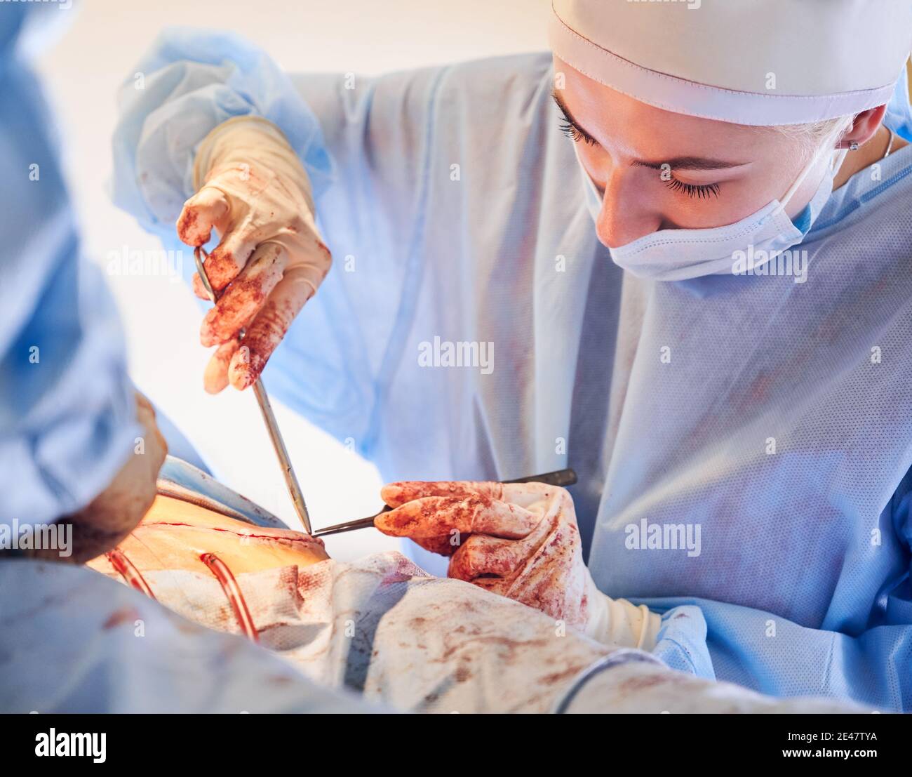 Gros plan de la jeune femme chirurgien dans des gants stériles en plaçant des sutures après la chirurgie tummy tummy. Femme médecin portant un uniforme chirurgical bleu et un masque médical lors de la chirurgie abdominale en plastique. Banque D'Images