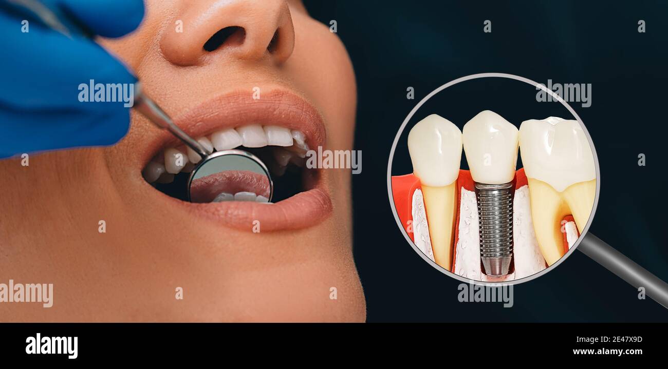 Dentisterie, publicité des prothèses dentaires. Implant dentaire près de la bouche ouverte du patient. Stomatologie moderne Banque D'Images