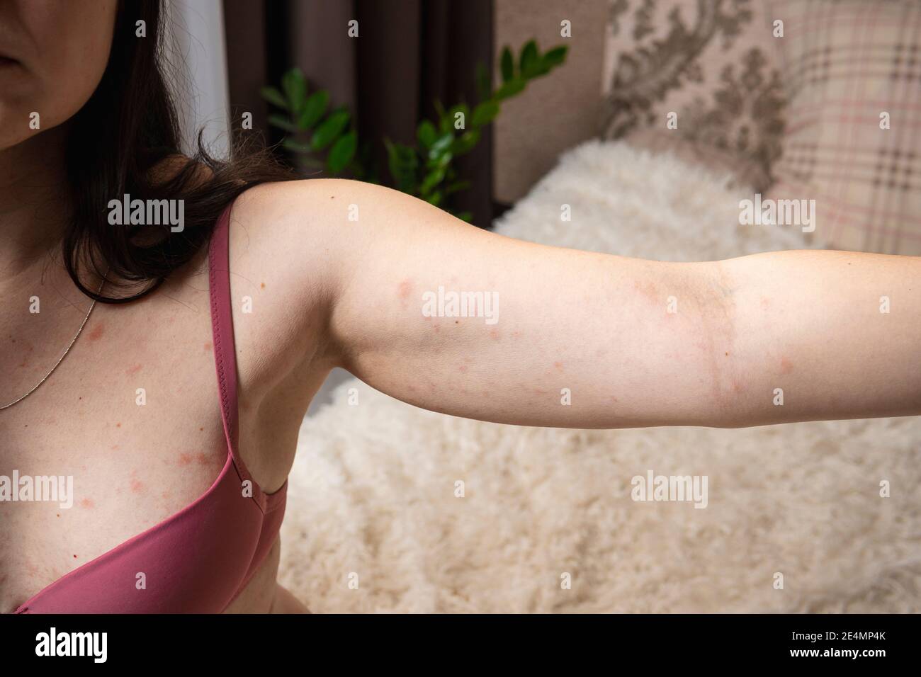 Les femmes présentant des symptômes d'urticaire itchy ou de réaction  allergique sur la peau. Éruption rouge sur le corps des femelles. Concepts  d'allergie, de maladies de la peau et de santé c