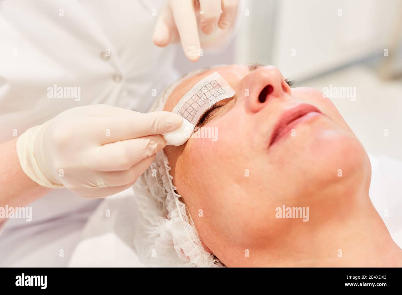 Patiente avec une marque sur son visage avant correction de la paupière dans la clinique de beauté Banque D'Images