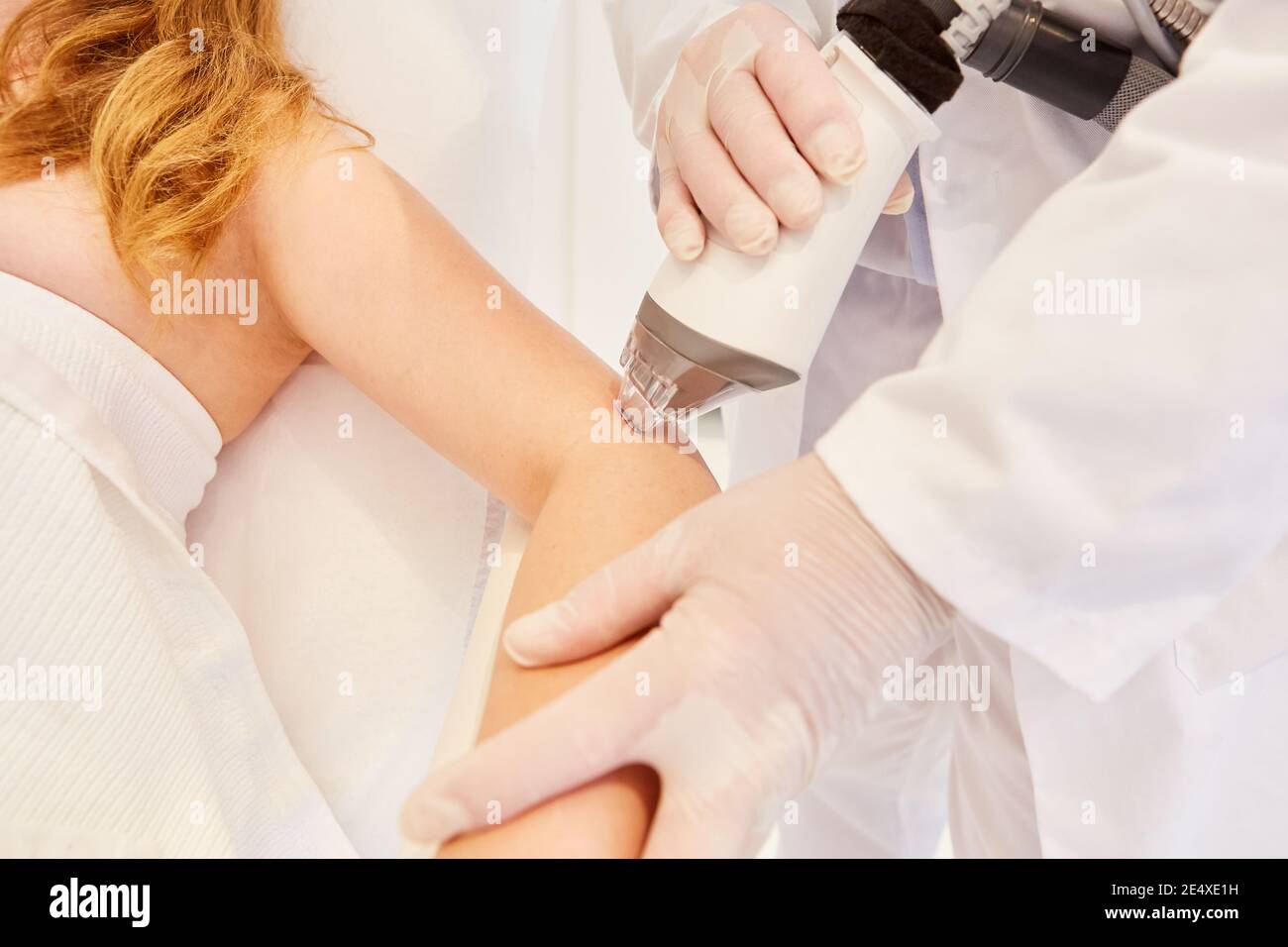 La femme reçoit une thérapie au laser sur la partie supérieure du bras avec le Laser Fraxel pour le serrage de la peau Banque D'Images