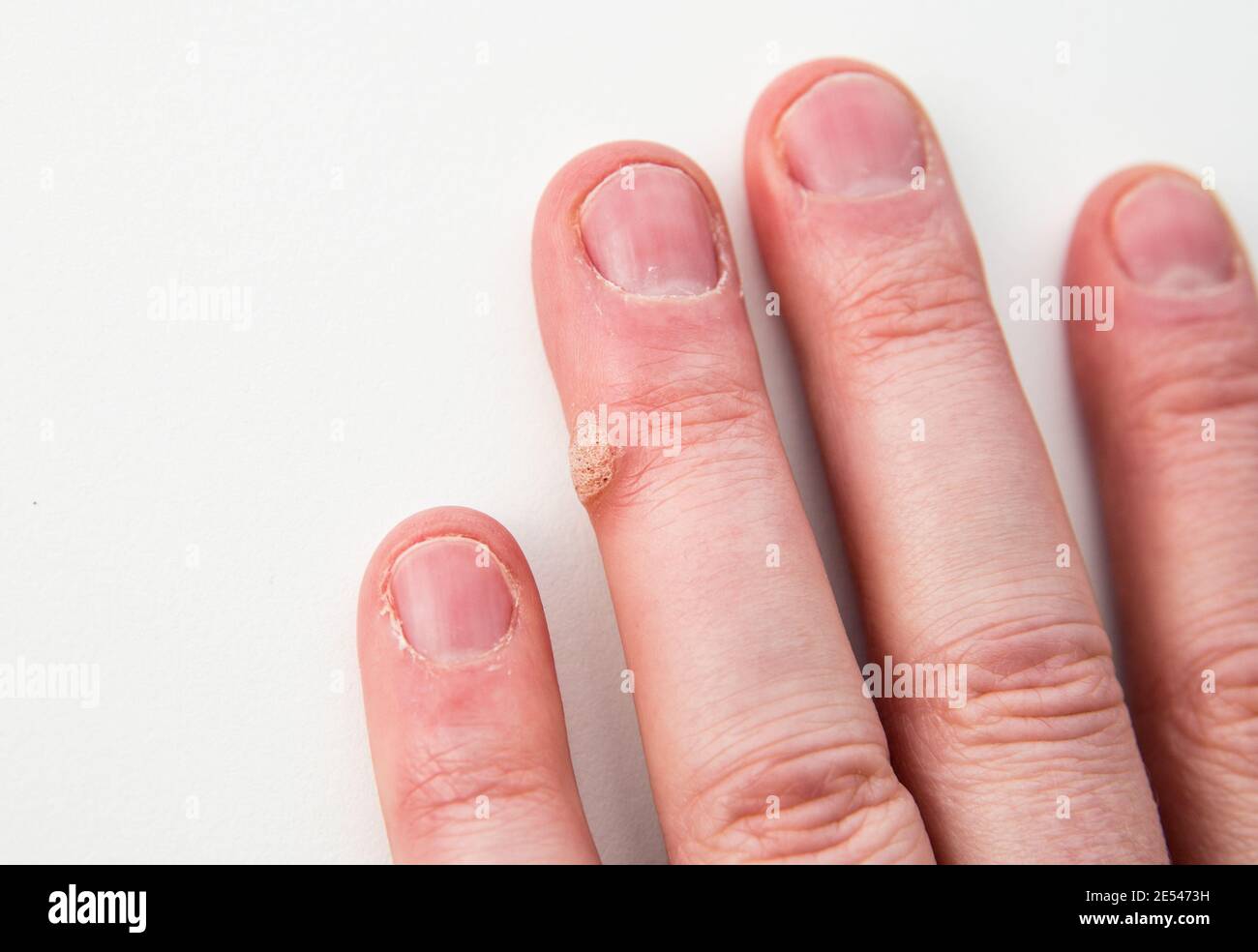 Vue rapprochée de la maladie de la peau appelée verrue causée par le virus du papillome humain sur le doigt humain. Banque D'Images