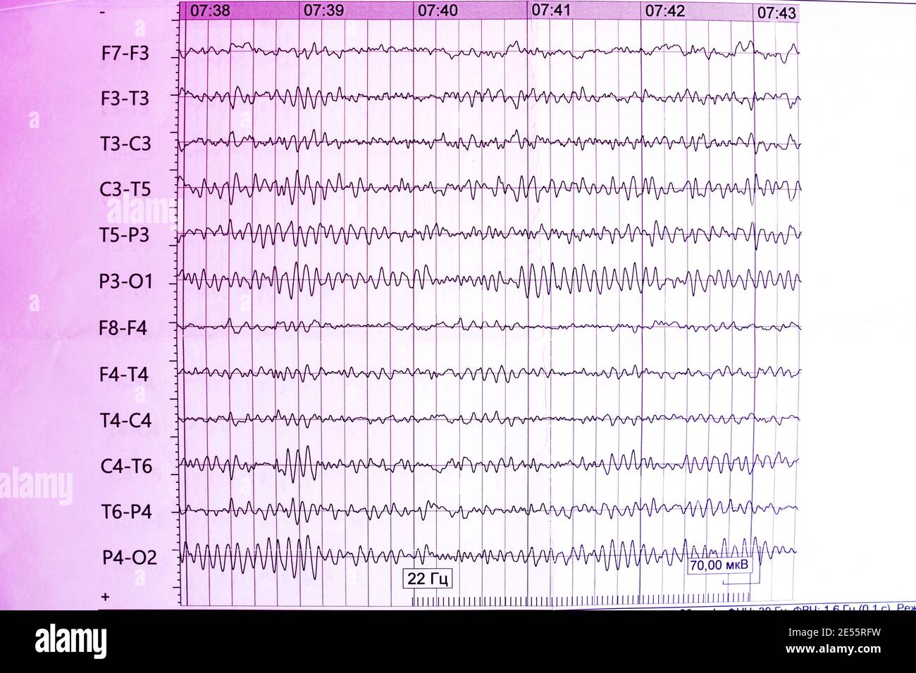 Les résultats de l'électroencéphalogramme sur papier, diagnostic de l'épilepsie Banque D'Images