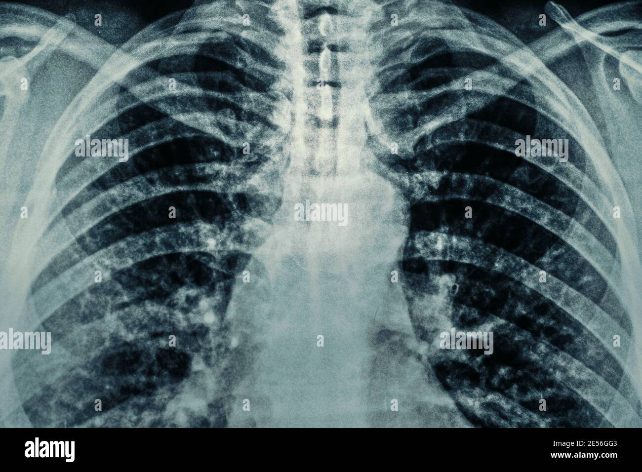 Radiographie thoracique asthme Banque de photographies et d'images ...