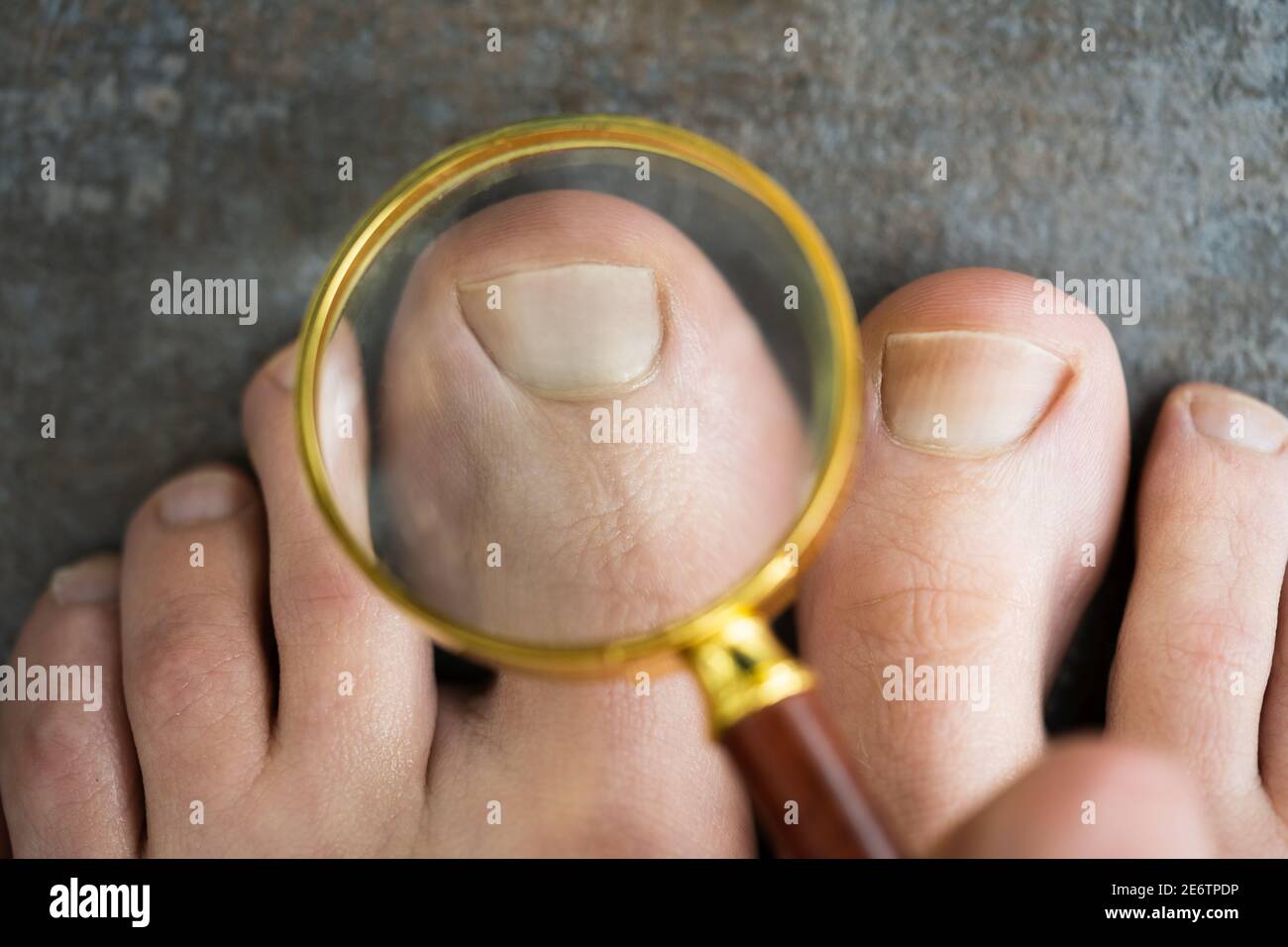 Ongle Incarne Banque D Image Et Photos Alamy