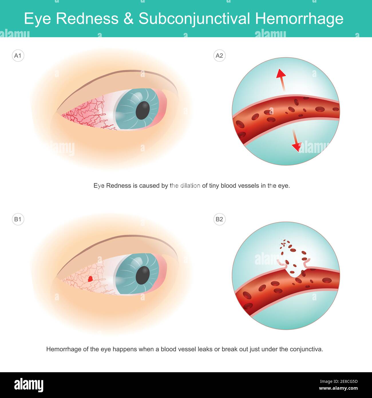 Rougeur oculaire et hémorragie sous-conjonctivale. La rougeur des yeux est causée par la dilatation de petits vaisseaux sanguins dans l'œil, et l'hémorragie de l'œil se produit Illustration de Vecteur