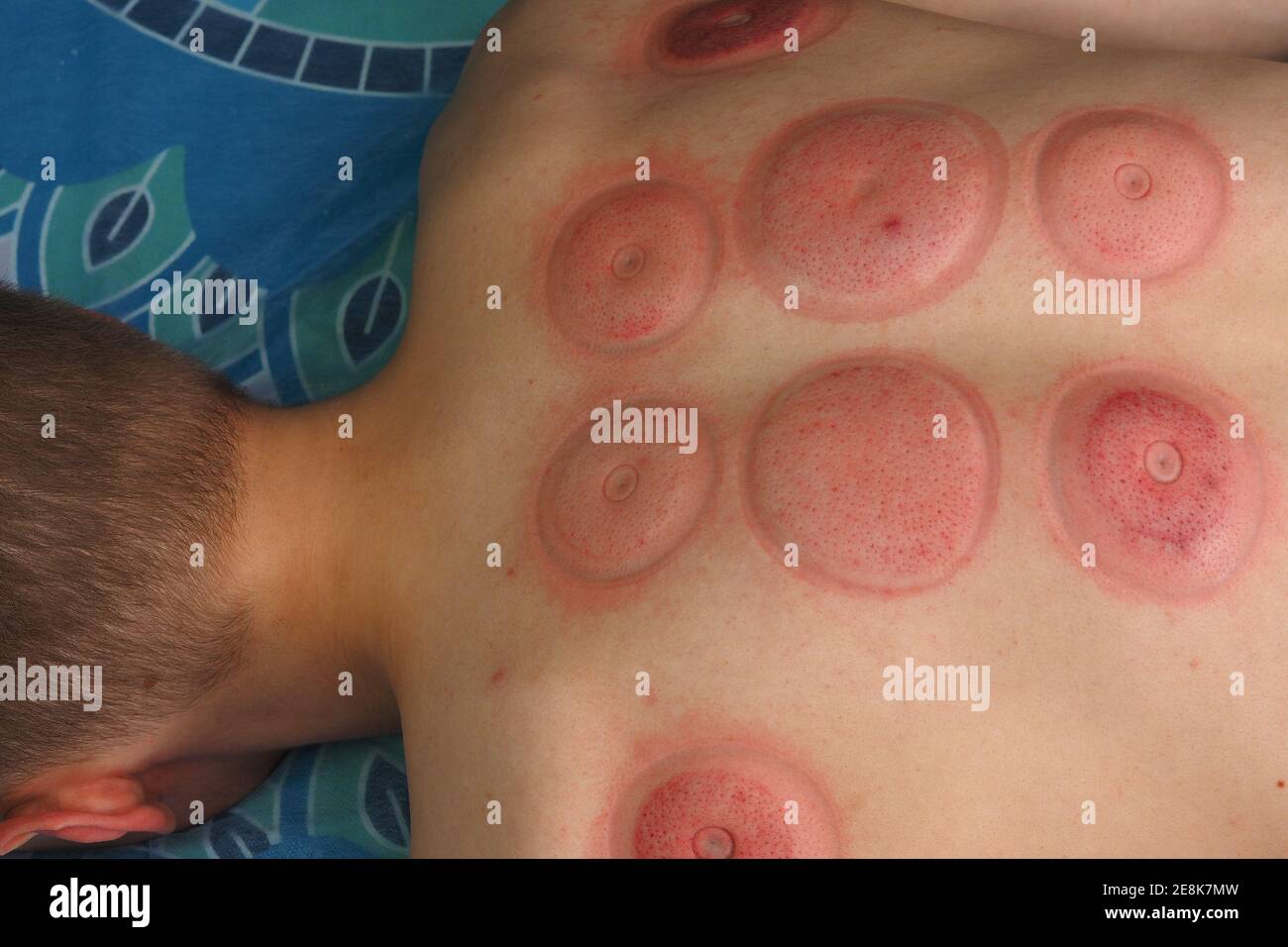 Pots à vide. Le massage est une contre-CAN. Massage du dos sous vide, corps masculin. Banque D'Images