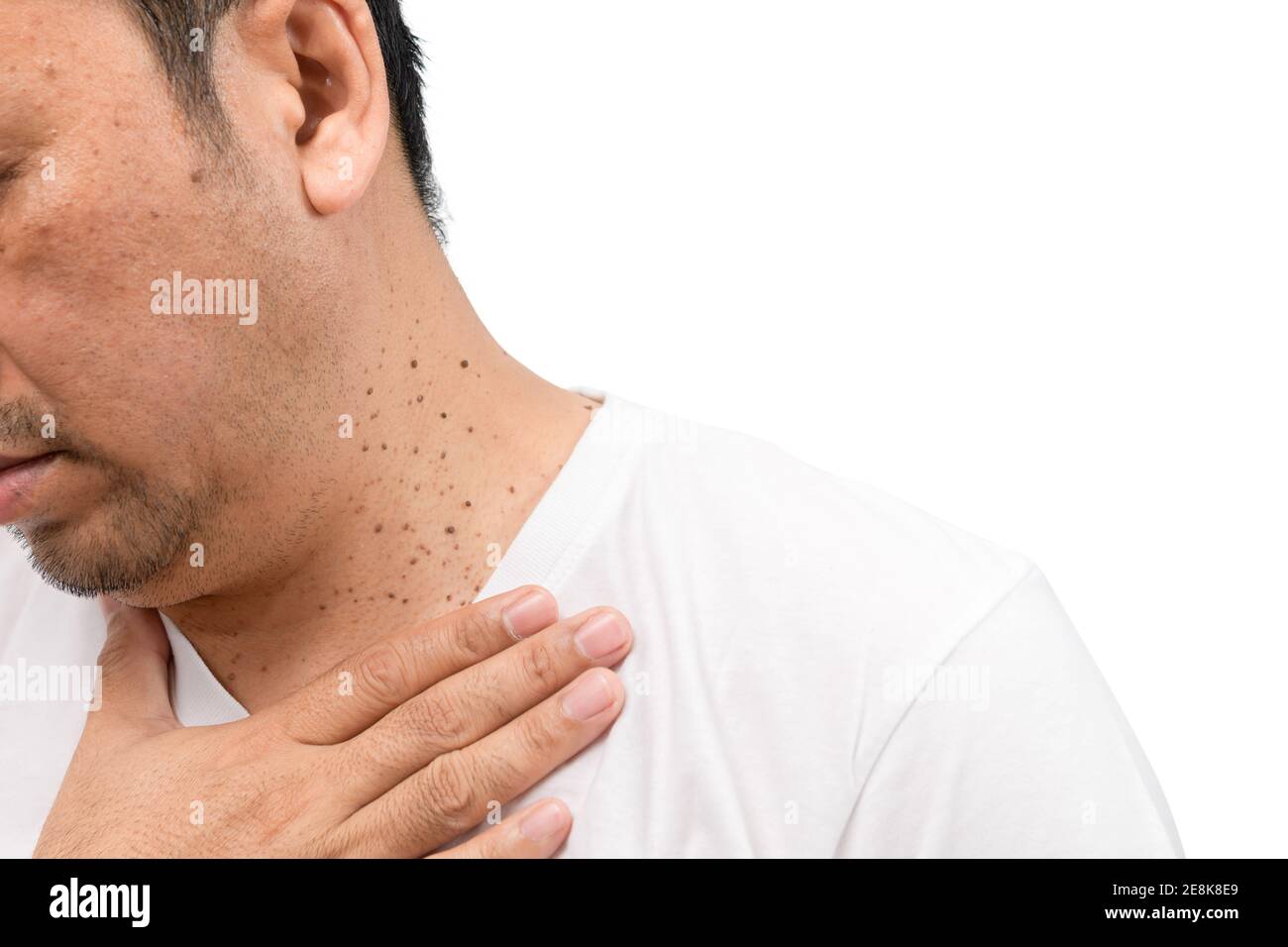 Fermé la peau Tags ou Acrochordon sur le cou homme isolé sur fond blanc. Concept de soins de santé Banque D'Images