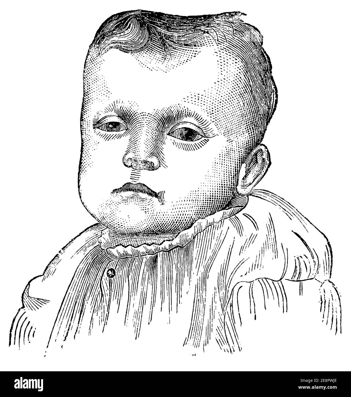 Formation et planéité du crâne chez un enfant de Rhachite. Illustration du 19e siècle. Allemagne. Arrière-plan blanc. Banque D'Images
