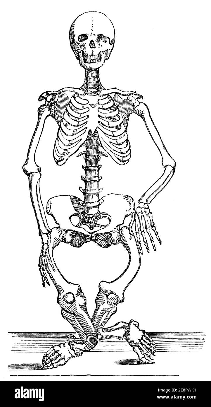 Squelette humain avec rickets. Illustration du 19e siècle. Allemagne. Arrière-plan blanc. Banque D'Images