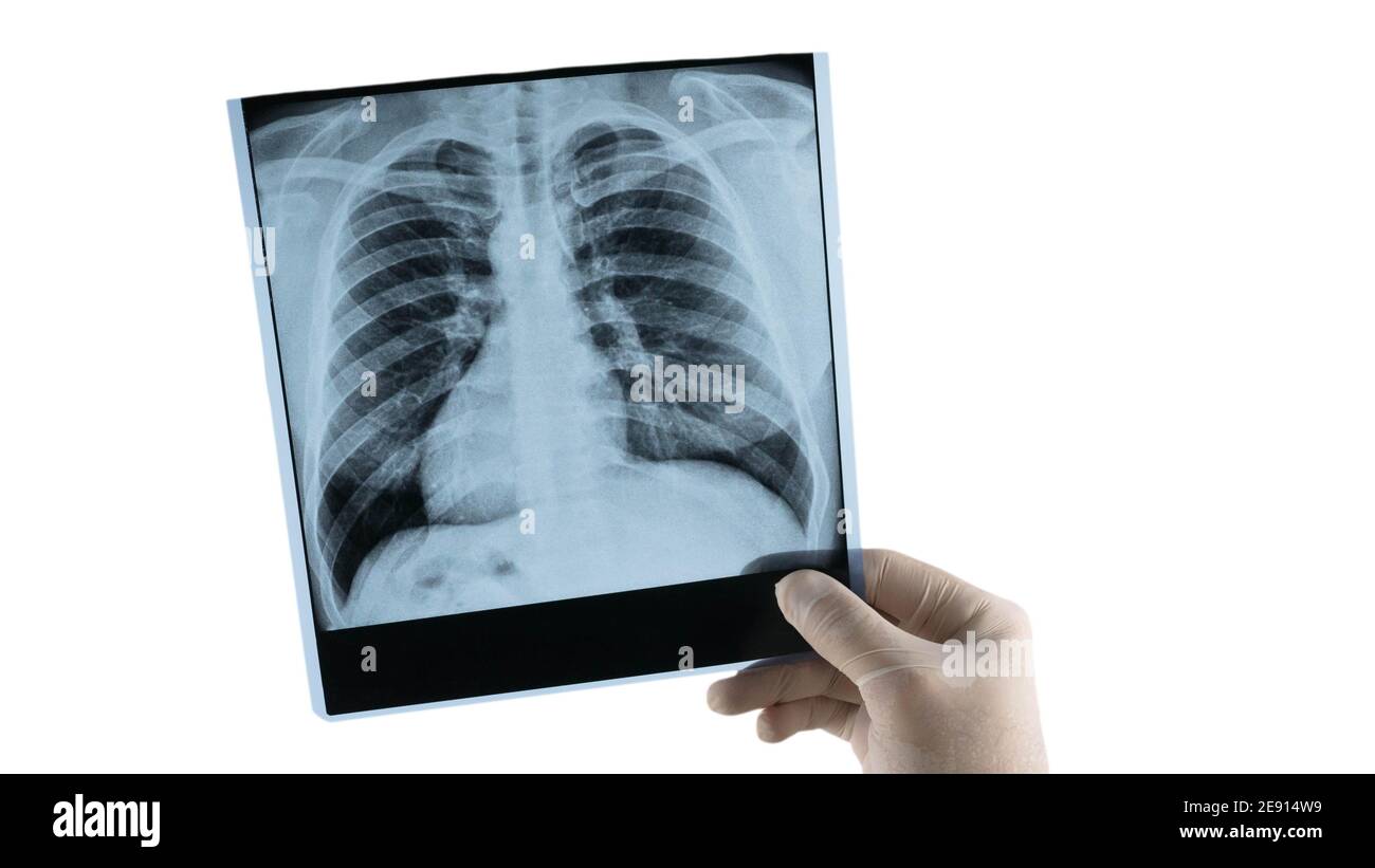 Image radiographique d'un homme dans les mains d'un médecin, un travailleur médical examine une radiographie des poumons. Pneumonie. Banque D'Images