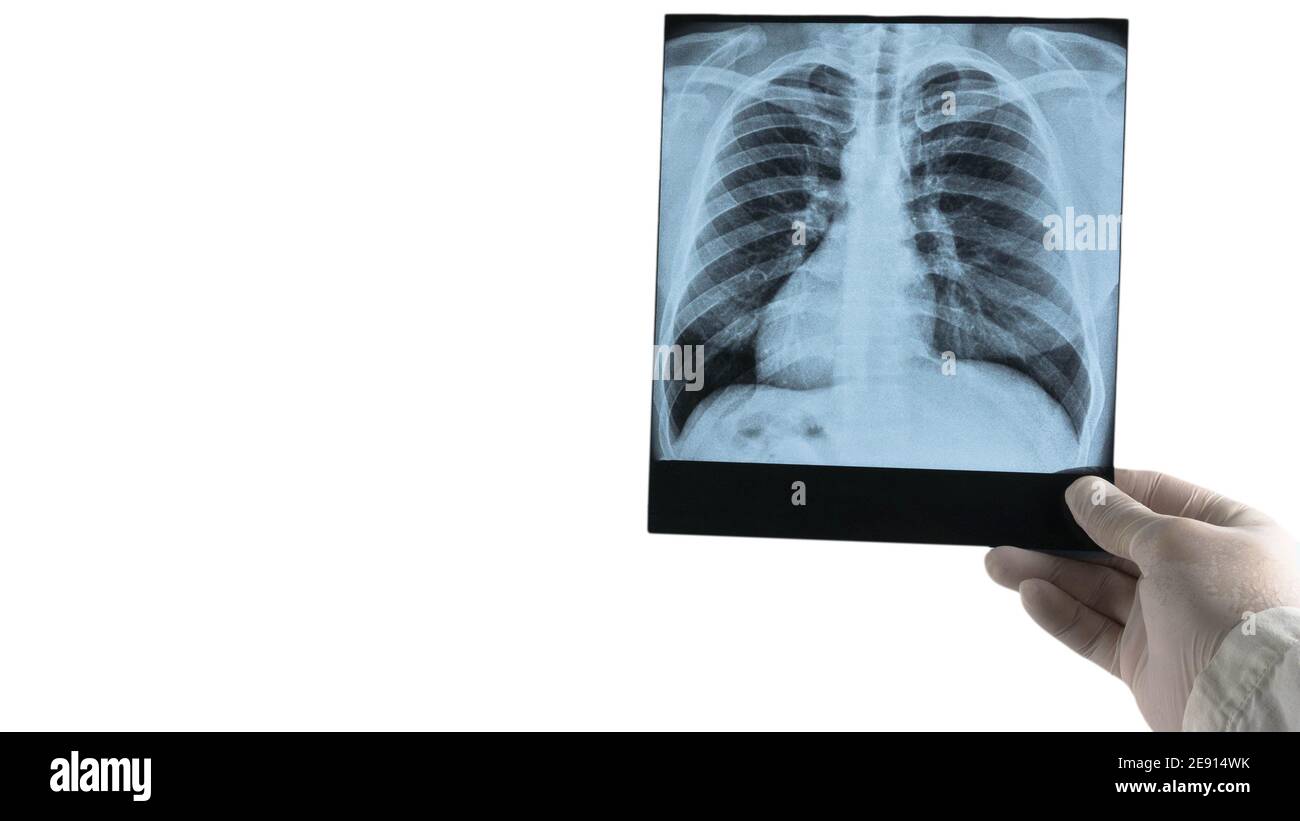 Radiographie des poumons humains sur fond blanc chez un médecin dans les mains d'un poumon à rayons X, un travailleur médical analyse la maladie de la pneumonie, respiratoire Banque D'Images