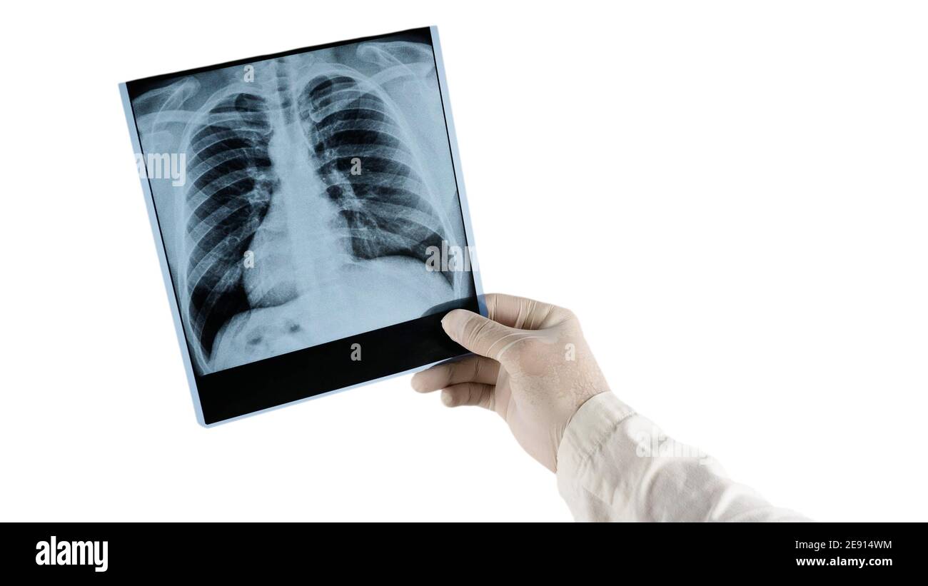Rayons X des poumons humains isolés sur fond blanc. Le médecin tient une radiographie des poumons dans ses mains. Banque D'Images