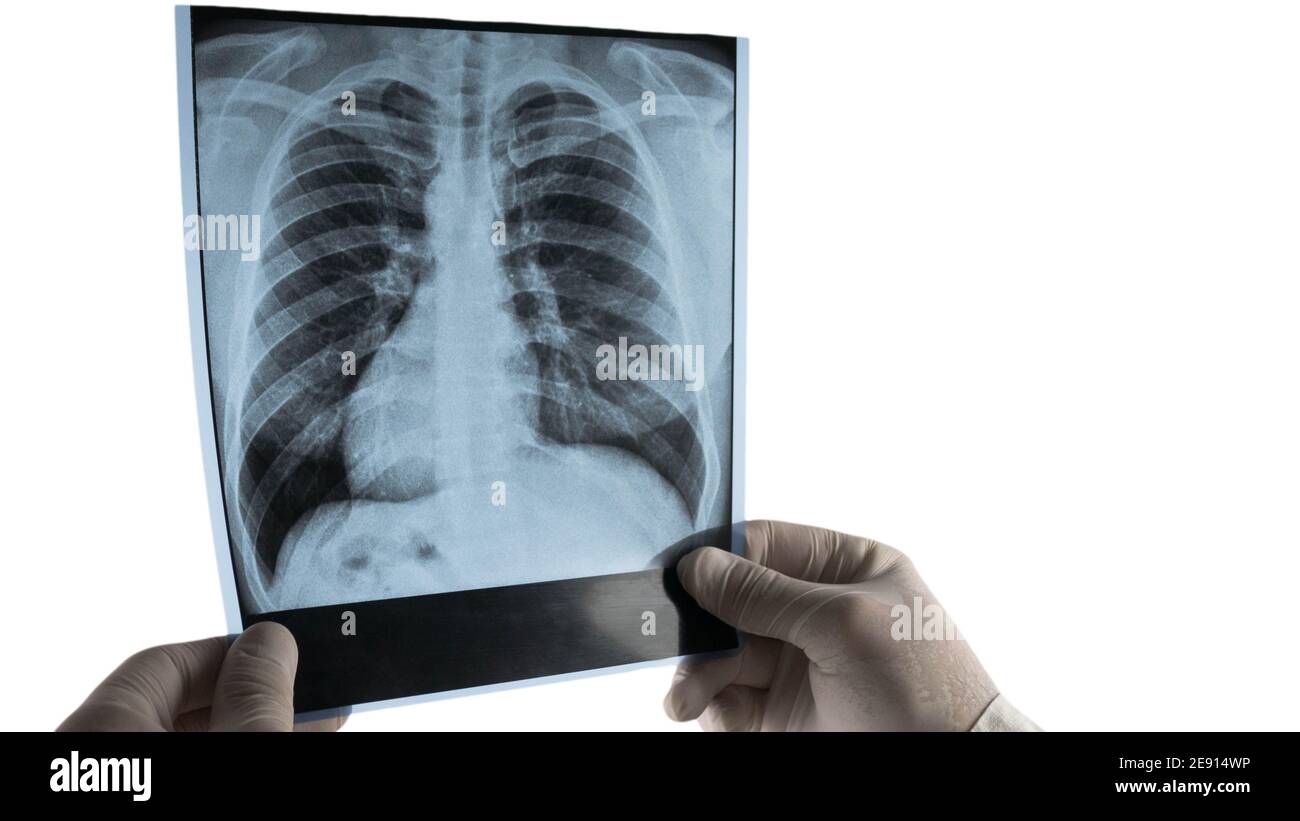 Radiographie des poumons humains à la main du médecin isolé sur fond blanc, le travailleur médical examine les maladies pulmonaires. Banque D'Images