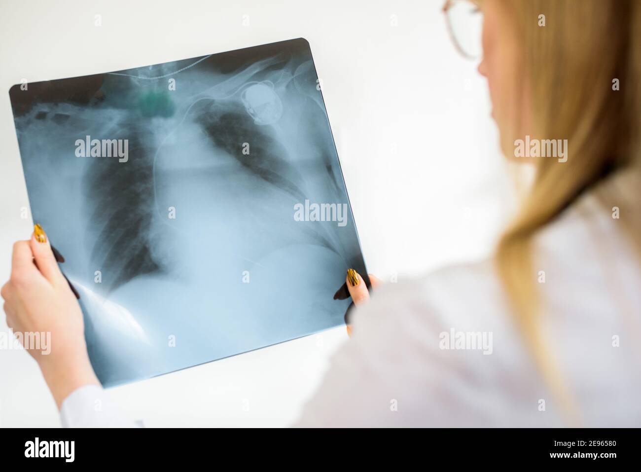 Un jeune médecin effacera un instantané des poumons. Diagnostic de pneumonie ou de tuberculose. Examen radiographique du patient. Banque D'Images